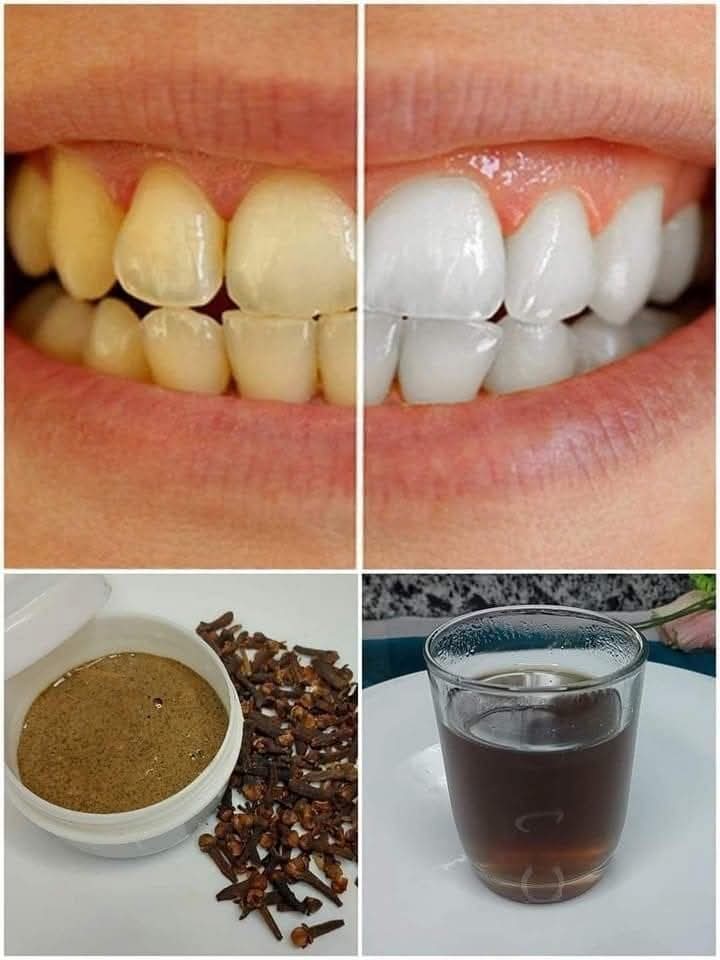 Beljenje zob: 7 preverjenih receptov, ki trajno odstranijo rumenenje