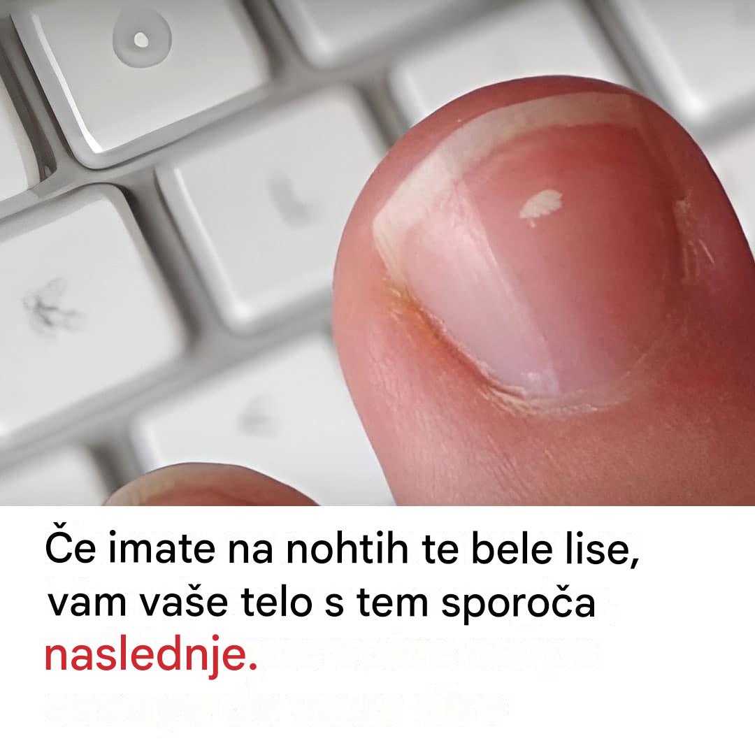 Beli pikčasti nohti: mit ali opozorilni znak?