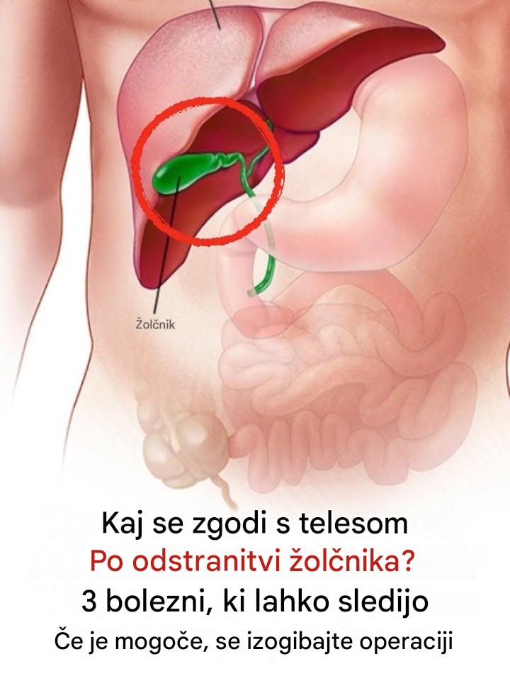 Kaj se zgodi s telesom po odstranitvi žolčnika? 3 bolezni, ki lahko sledijo – če je mogoče, se izogibajte operaciji