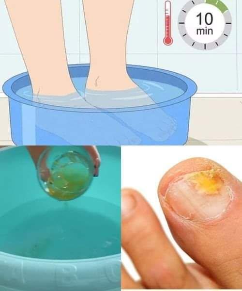 ADIJO, GLIVICE NA NOHTIH, UNIČIJO JIH V NEKAJ SEKUND!!